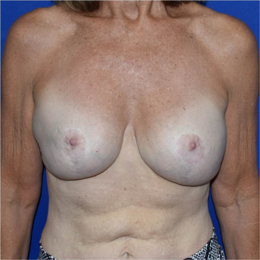 Patient 14, view 1 view before implant removal