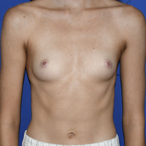 Patient 01, front view before mini breast augmentation