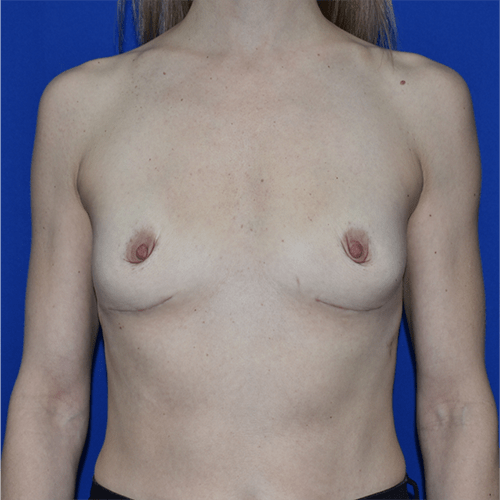 Patient 10, view 1 view after implant removal