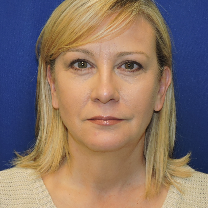 Patient 03, view 1 view after chin augmentation
