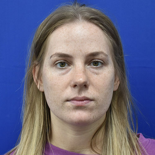 Patient 09, front (1) view before blepharoplasty