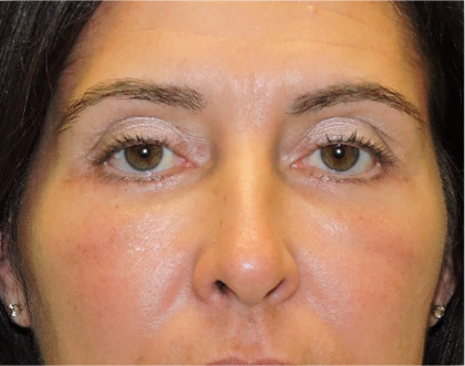 Patient 18, view 1 view after blepharoplasty