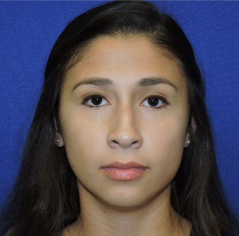 Patient 31, view 1 view before rhinoplasty