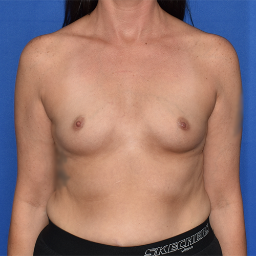 Patient 131, view 1 view before breast augmentation