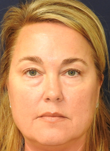 Patient 20, view 1 view before blepharoplasty