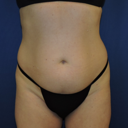 Patient 16, view 1 view before liposuction