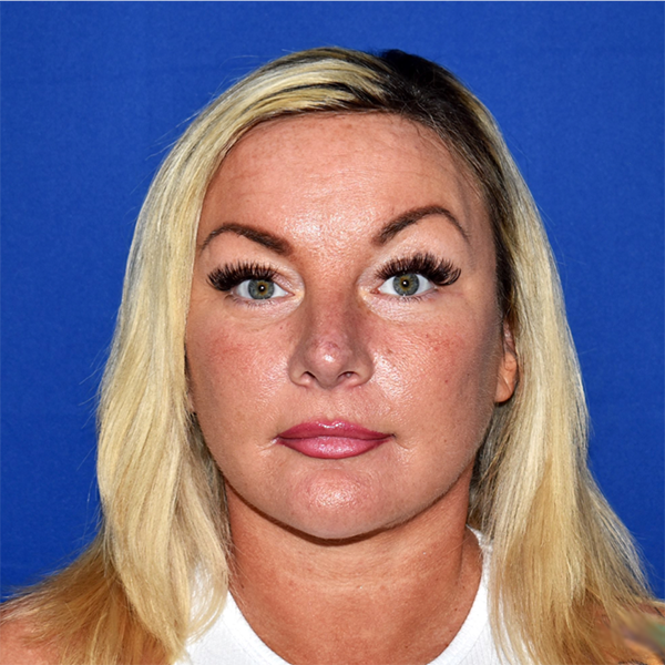 Patient 02, view 1 view after blepharoplasty