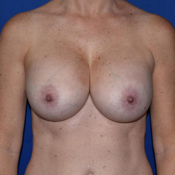 Patient 78, view 1 view after breast augmentation