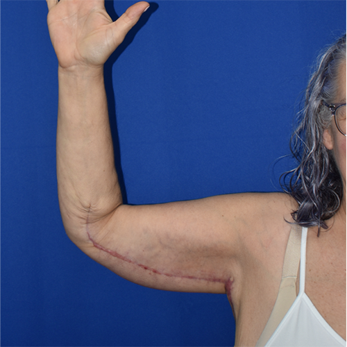 Patient 09, front (1) view after arm lift