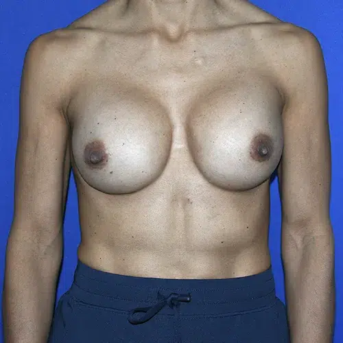 Patient 09, front view after breast implant revision