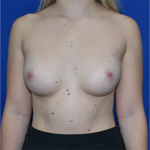 Patient 04, front view before nipple correction