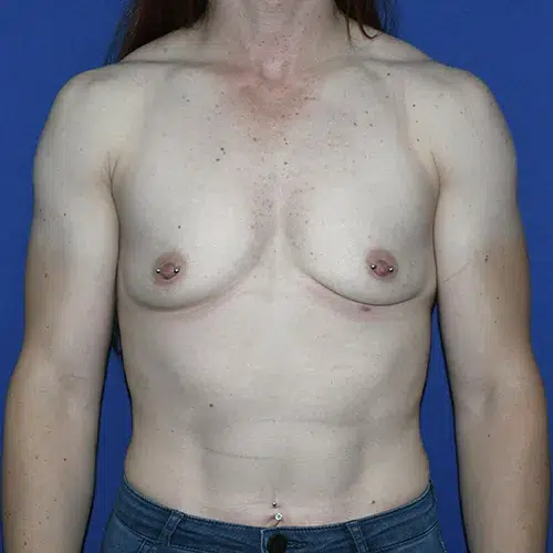 Patient 07, front view before mini breast augmentation