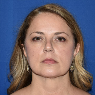 Patient 06, view 1 view after chin augmentation