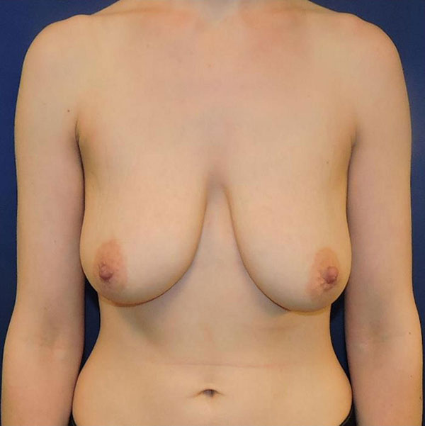 Patient 51, view 1 view before breast augmentation with lift