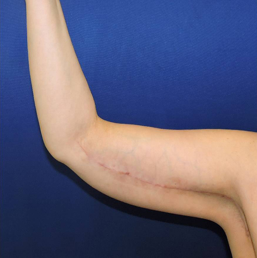 Patient 04, view 1 view after arm lift