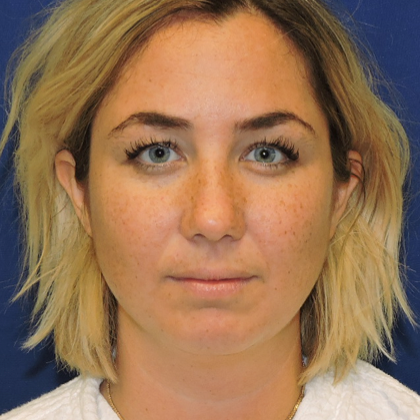 Patient 15, view 1 view before chin liposuction