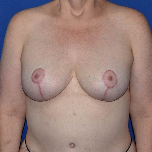 Patient 13, view 1 view after breast lift