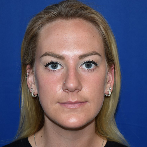Patient 18, view 1 view before rhinoplasty