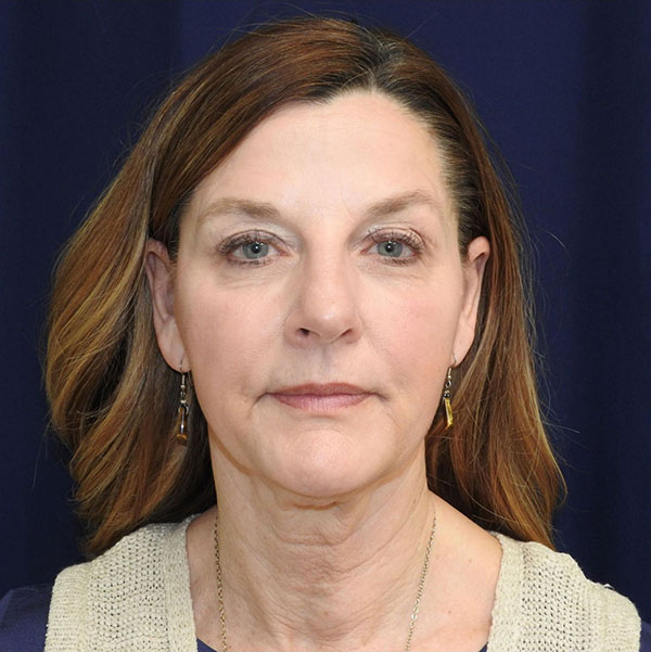 Patient 22, view 1 view before facelift