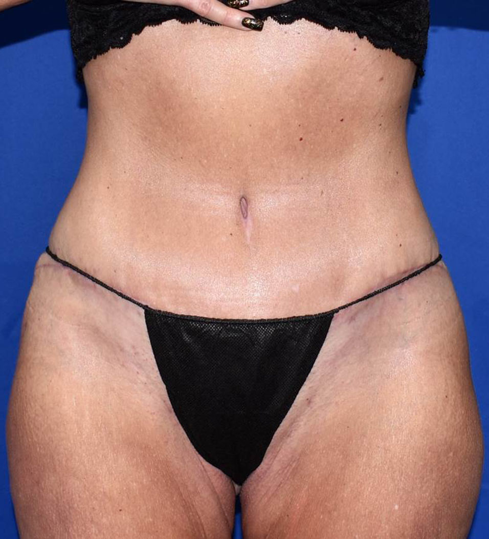 Patient 14, view 1 view after tummy tuck