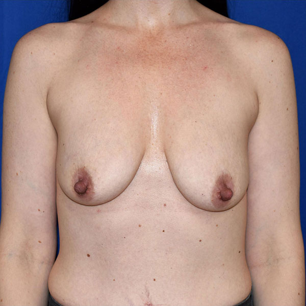Patient 04, view 1 view before breast augmentation with lift