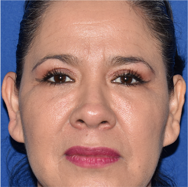 Patient 17, view 1 view after blepharoplasty
