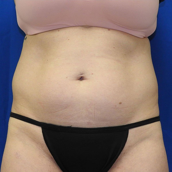 Patient 18, view 1 view before liposuction
