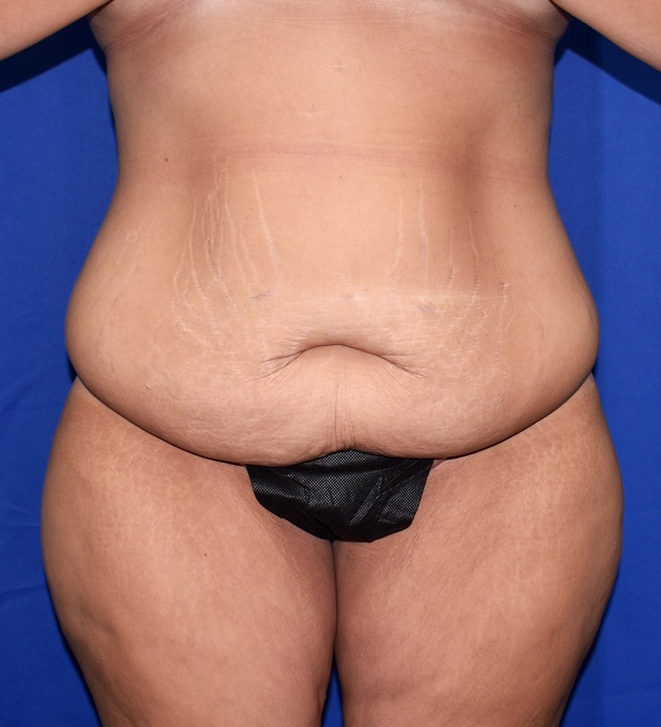 Patient 11, view 1 view before tummy tuck