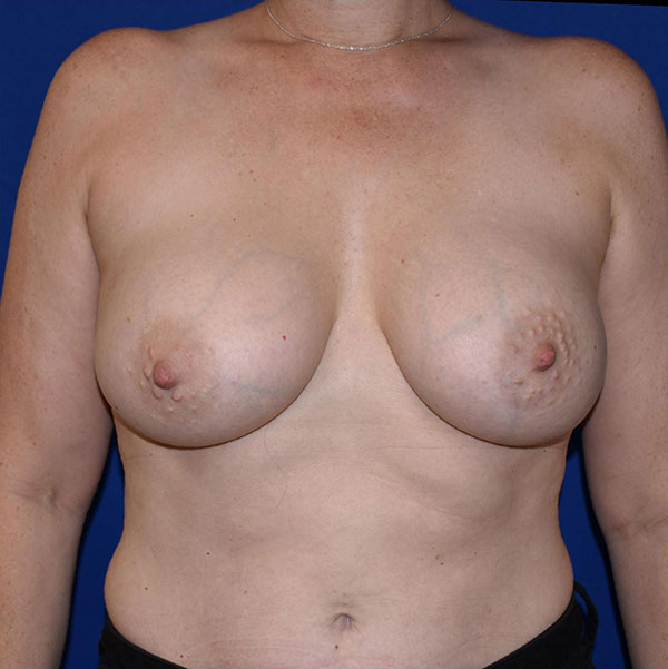 Patient 100, view 1 view after breast augmentation