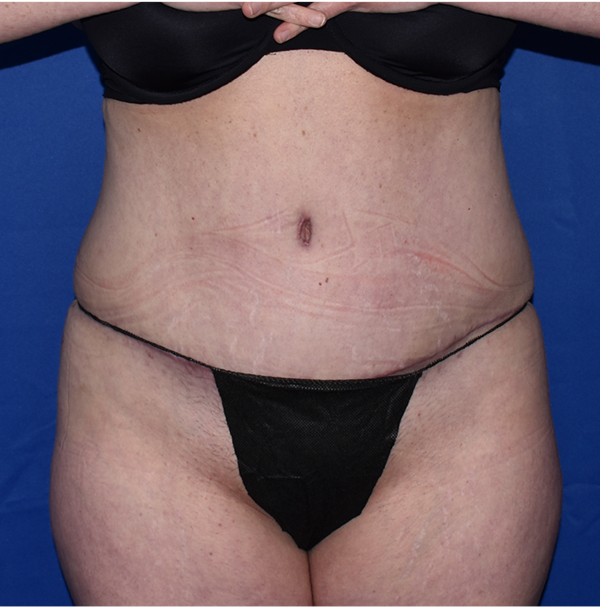 Patient 09, view 1 view after tummy tuck