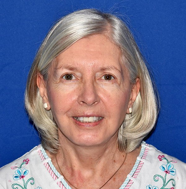 Patient 26, view 1 view after facelift
