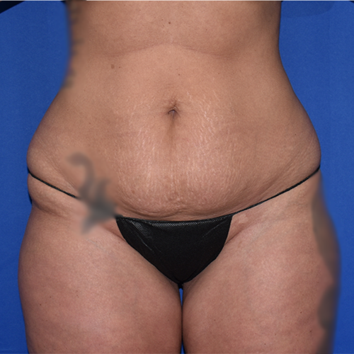 Patient 39, view 1 view before tummy tuck