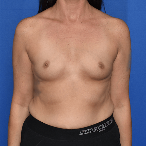 Patient 126, view 1 view before breast augmentation