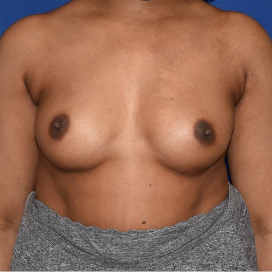 Patient 107, view 1 view before breast augmentation