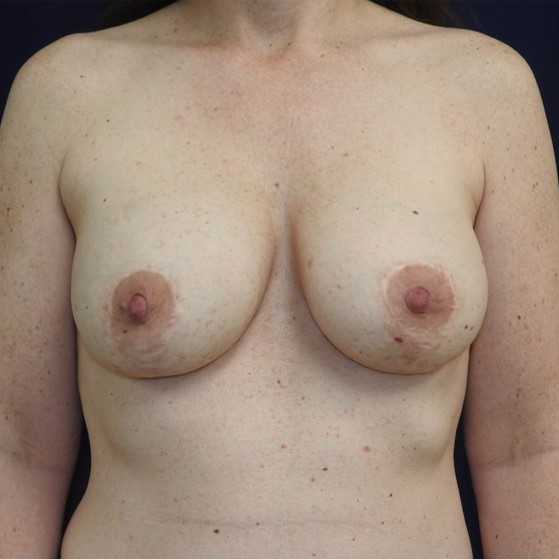 Patient 06, view 1 view before implant removal