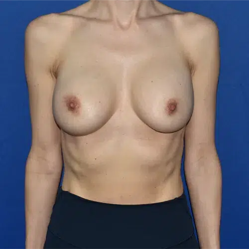 Patient 140, front view before breast augmentation