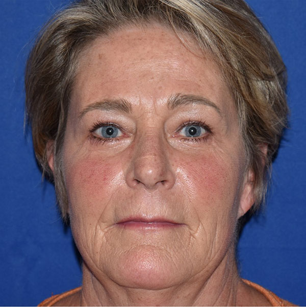 Patient 03, view 1 view after blepharoplasty