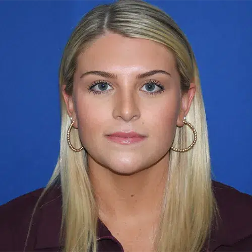 Patient 08, front view after rhinoplasty