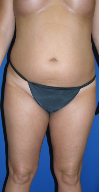 Patient 21, view 1 view before liposuction