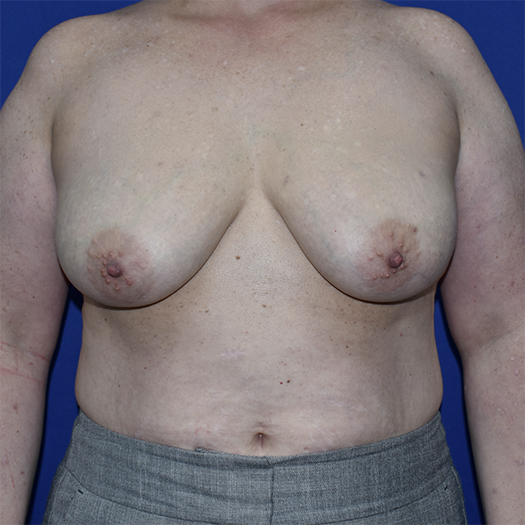 Patient 14, view 1 view before breast lift