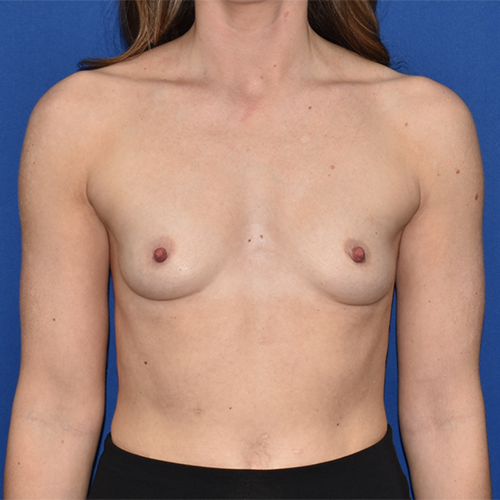 Patient 05, view 1 view before mini breast augmentation