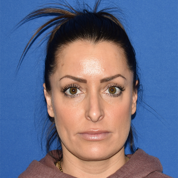 Patient 35, view 1 view before rhinoplasty