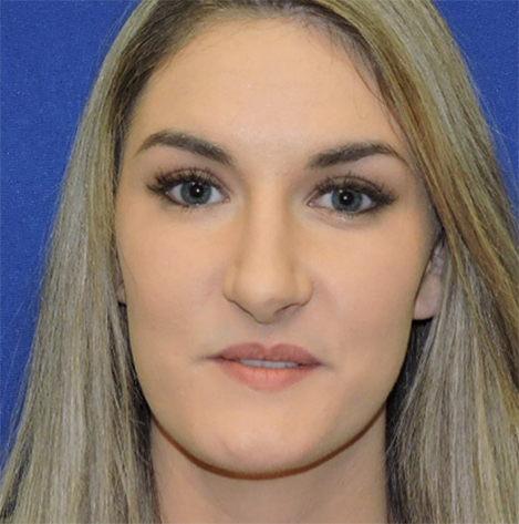 Patient 32, view 1 view after rhinoplasty