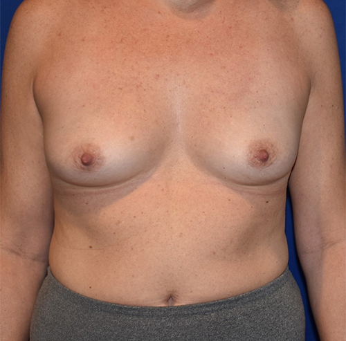 Patient 111, view 1 view before breast augmentation
