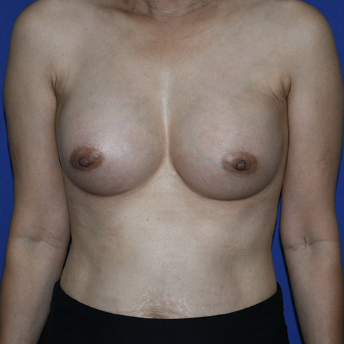 Patient 30, front view after breast augmentation