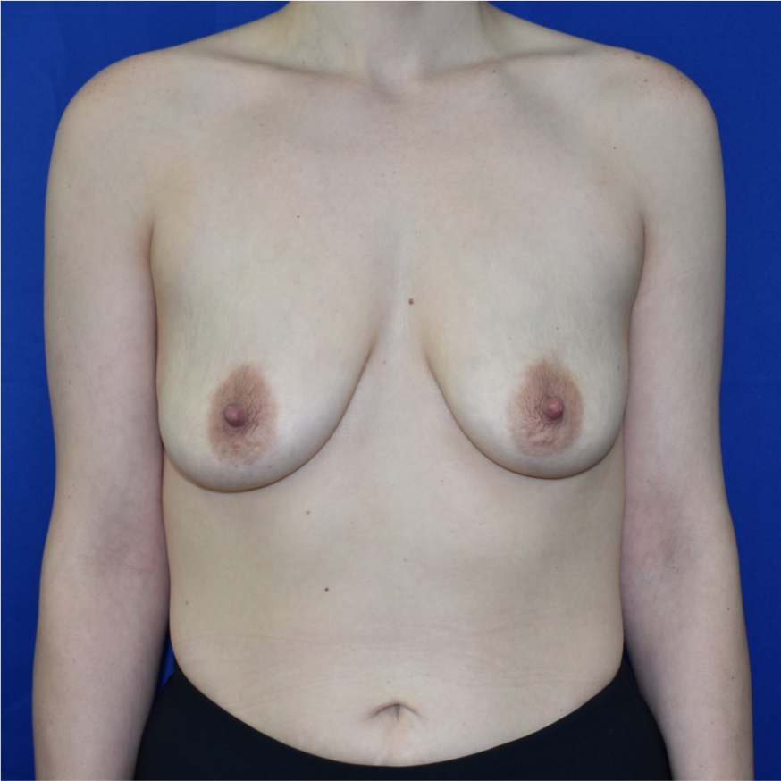 Patient 07, view 1 view before breast augmentation with lift