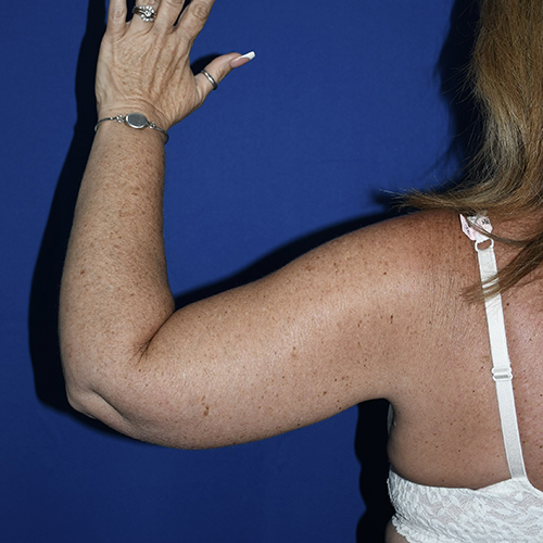 Patient 10, view 1 view after arm lift