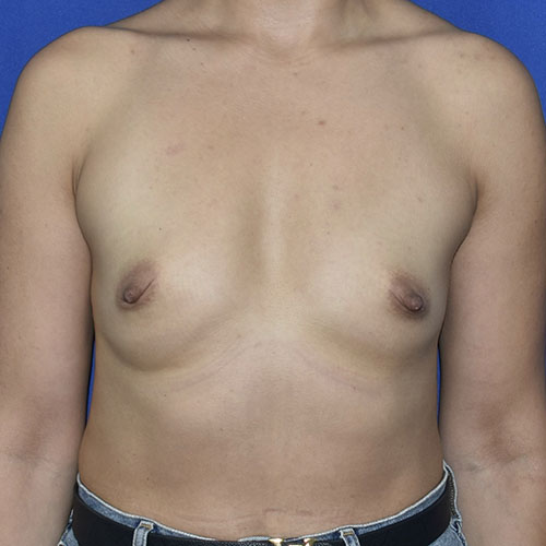 Patient 144, front view before breast augmentation