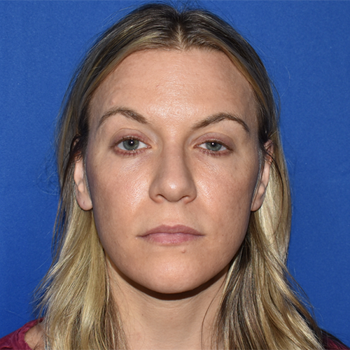 Patient 10, front view after facial fat grafting