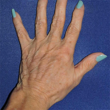 Selected view after hand rejuvenation